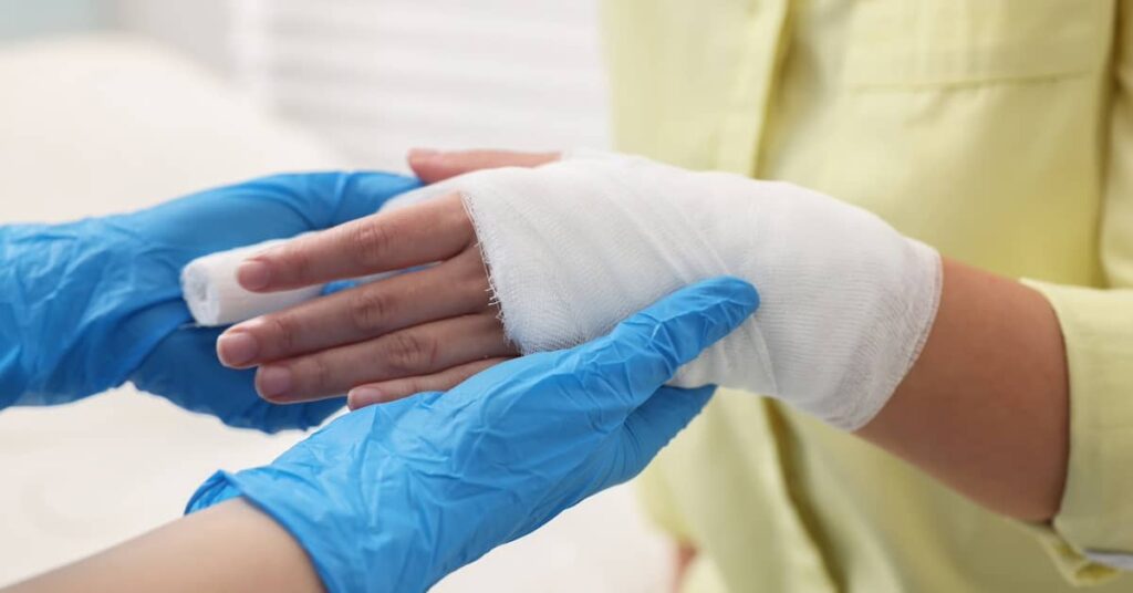 Treatment for a burn injury on a person's hand | Burg Simpson