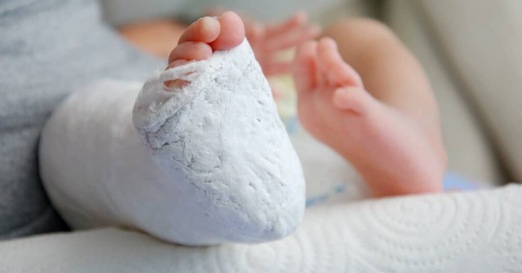 Newborn baby with cast on broken leg after birth injury | Burg Simpson